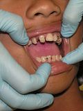 Top 10 Countries With the Worst Teeth, Oral Health and Hygiene in the World