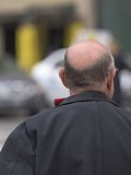 20 Countries with Highest Rates of Hair Loss
