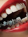 15 Best Countries for Dental Implants